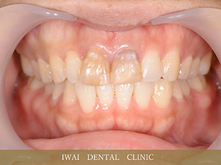 前歯の治療例（1）