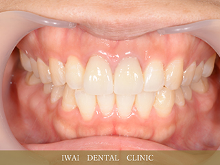 前歯の治療例（1）