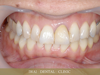 前歯の治療例（2）