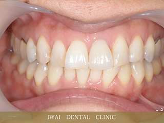 前歯の治療例（2）