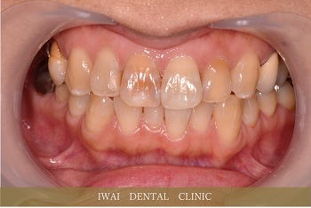 前歯の治療例（3）