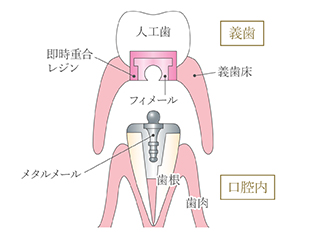 クーゲルホック