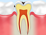 C1エナメル質の虫歯