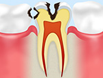 C2象牙質の虫歯