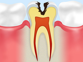 02 虫歯になる