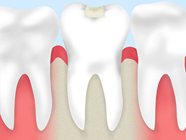 03 歯を削り詰め物をする