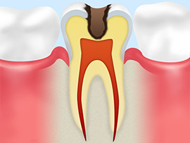 04 虫歯が再発する