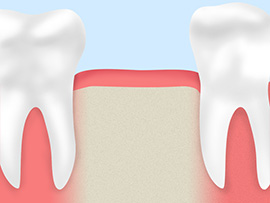 07 虫歯が歯根まで達し抜歯となる