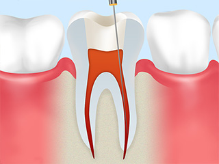 根管治療について