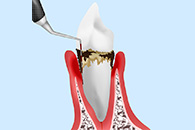 歯周精密検査