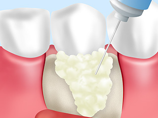 歯周再生療法(エムドゲイン)