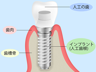 インプラント治療