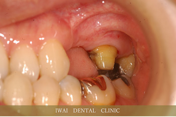 奥歯の治療例（1）