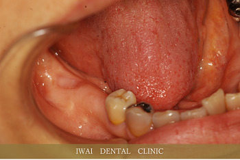 奥歯の治療例（2）