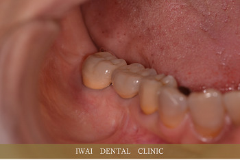奥歯の治療例（2）