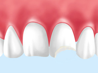 外傷（歯の破折）